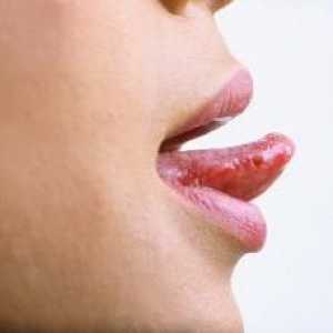Лечение на стоматит на езика с различни форми на заболяването
