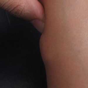 Липома (мастна тъкан) на краката: причини, симптоми и лечение
