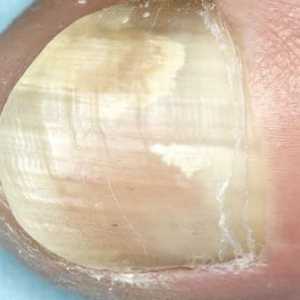 Микозата на ноктите: как да се избягва и как да се лекува