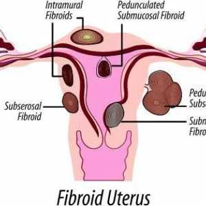 Миома на матката: размерите на операцията. Маточни фиброиди: съвременни методи на лечение