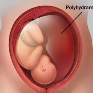 Полихидрамнион по време на бременност: причини и последици. Ефект на полихидрамините върху раждането