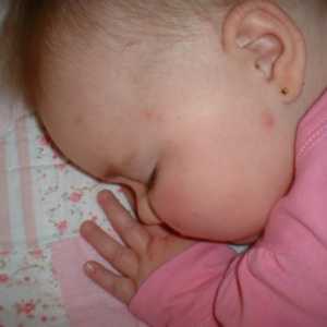 Molluscum при детето: причини, симптоми и методи на лечение