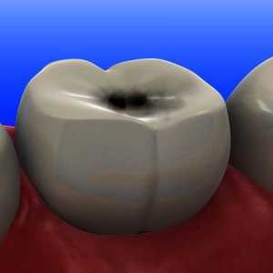 На зъбите черни точки: какво да правя?