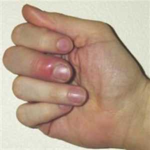 Изхвърля пръст на ръка: причини, симптоми и метод на лечение