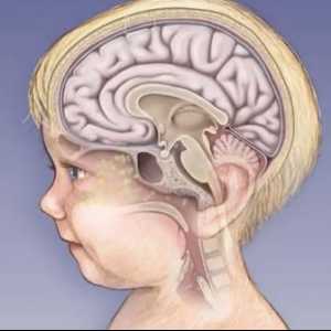 Колко сериозни са ефектите от менингита при децата?