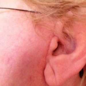 Няколко обяснения за причините за изгарянето на ушите или бузите