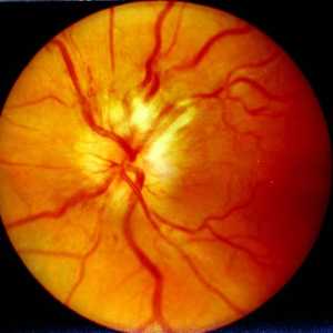 Очен неврит: причини, симптоми, диагноза и функции на лечение
