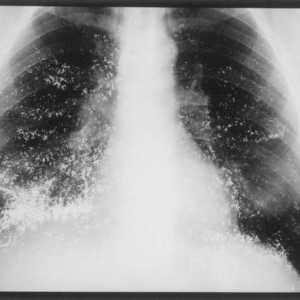Нозокомиална пневмония: патогени, лечение и профилактика