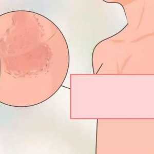 Кърмене под млечните жлези: лечение с народни средства, снимка