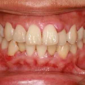 Венците се набъбват, но зъбът не боли - какво да правим или правим? Причини за подуване на венците…