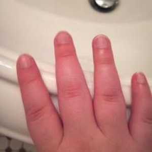 Пухкави пръсти на ръцете: причини, диагноза, лечение. Какво да направите, ако ставите на пръстите…