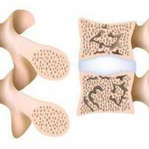 Остеопороза на гръбначния стълб: симптоми и лечение с народни средства