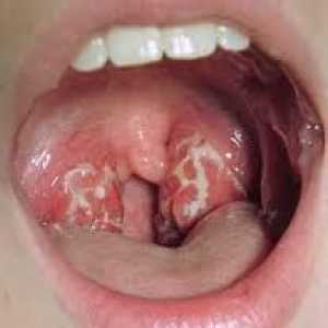 Къде е стафилококът в гърлото? Симптомите на инфекцията
