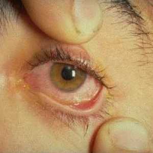 Изгаряне на очите: първа помощ и лечение