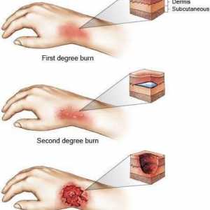 Изгаряния: изгаряния в района, определяне от правилото на дланта. Класификация на изгарянията по…