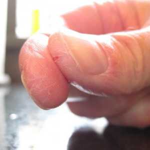 Пръстите на ръцете се крекират: причините и лечението