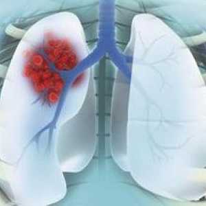 Периферна рак на белите дробове: етапи, лечение, медицинска история. Карцином на периферния лоб