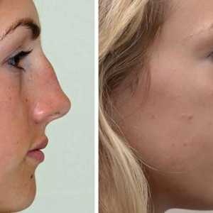 Пластична хирургия на носа: снимки, отзиви