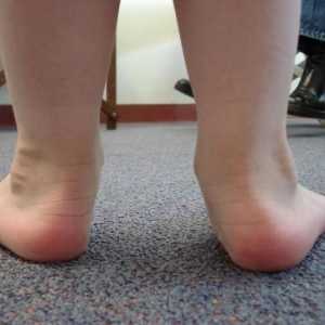 Ploskovolgusnye крака на детето. Методи на лечение