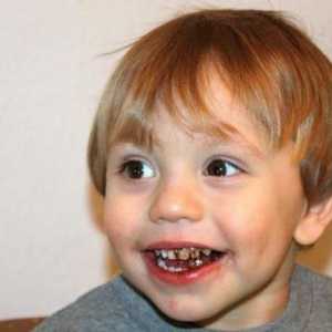 Защо са черни зъби на детето: възможни причини, как да се реши проблема