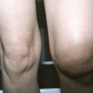 Защо коляното е подуто и болезнено? Причини и лечение