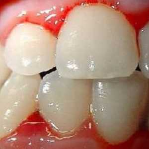 Защо венците кърви и какво трябва да направя?