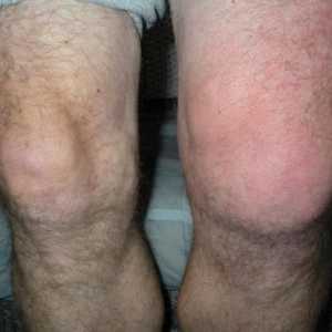 Защо коляното ми се надига?