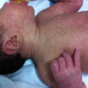 Защо мраморната кожа се появява в бебето?