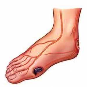 В детайли за това какво и как да се лекуват трофичните язви по краката