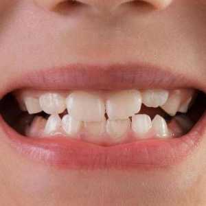 Мобилност на зъбите: степен, причини, лечение