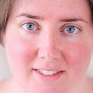 Зачервяване на кожата на лицето: причини и как да го премахнете