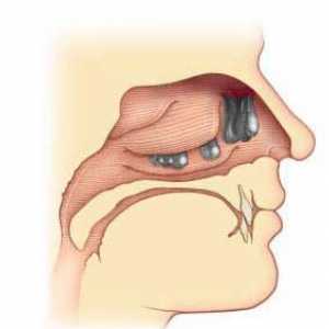 Полипи в носа: лечение без хирургия. Лечение на полип в носа с народни средства
