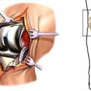 Последици от наранявания на колянната става. Протезиране и рехабилитация