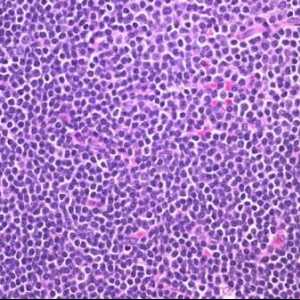 Повишени лимфоцити в кръвта на децата - опасно ли е?