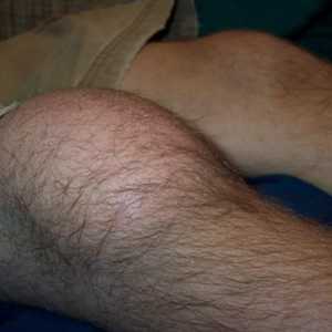 Предпаратичен бурсит на колянната става: симптоми и лечение
