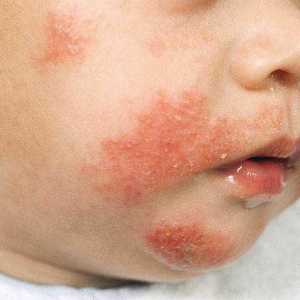 Причини и симптоми на атопичен дерматит при деца