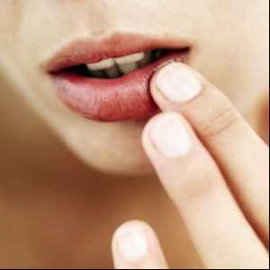 Причини и лечение на пукнатини в ъглите на устните