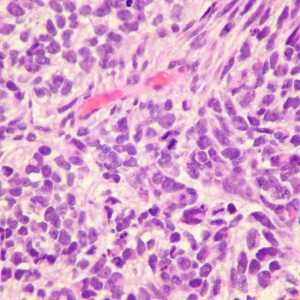 Малък клетъчен рак на белия дроб: диагноза, лечение, прогноза