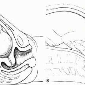 Разкриване на шийката на матката с 2 пръста: кога да се роди? Симптоми на цервикална дилатация