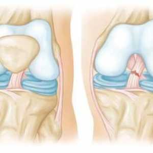 Разкъсване на сухожилията на колянната става