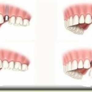 Възстановяване на зъба: кога и как да приложите процедурата?