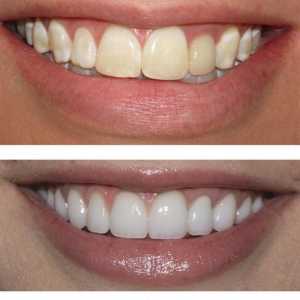 Възстановяване на зъбите: преди и след. Изкуството възстановяване на зъбите