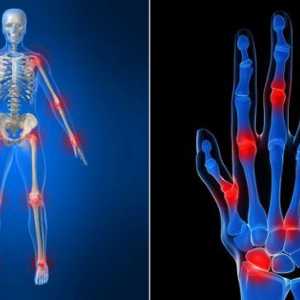 Ревматоиден артрит: симптоми и лечение