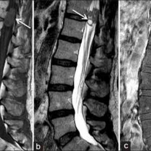 Сарком на гръбначния стълб: диагноза и лечение