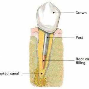 Щифтове в стоматологията: инсталация, рецензии, цени
