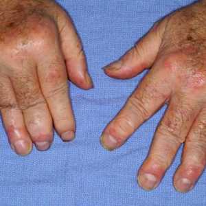 Симптоми и лечение на псориатичен артрит