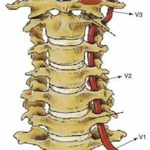 Синдром на гръбначната артерия с цервикална остеохондроза: симптоми и лечение
