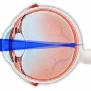 Комплексен миопсистичен астигматизъм на двете очи при деца: лечение
