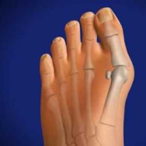 Степени на деформация на крака и методи за лечение на тази патология