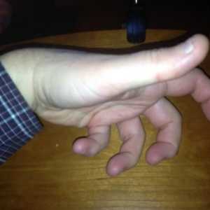 Slylo пръст на ръката: причини, лечение и превенция